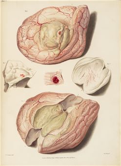 Reports of Medical Cases, Selected with a View of Illustrating the Symptoms and Cure of Diseases by a Reference to Morbid Anatomy. London: Longman, Rees, Orme, Brown, and Green, 1827-1831 - William Say