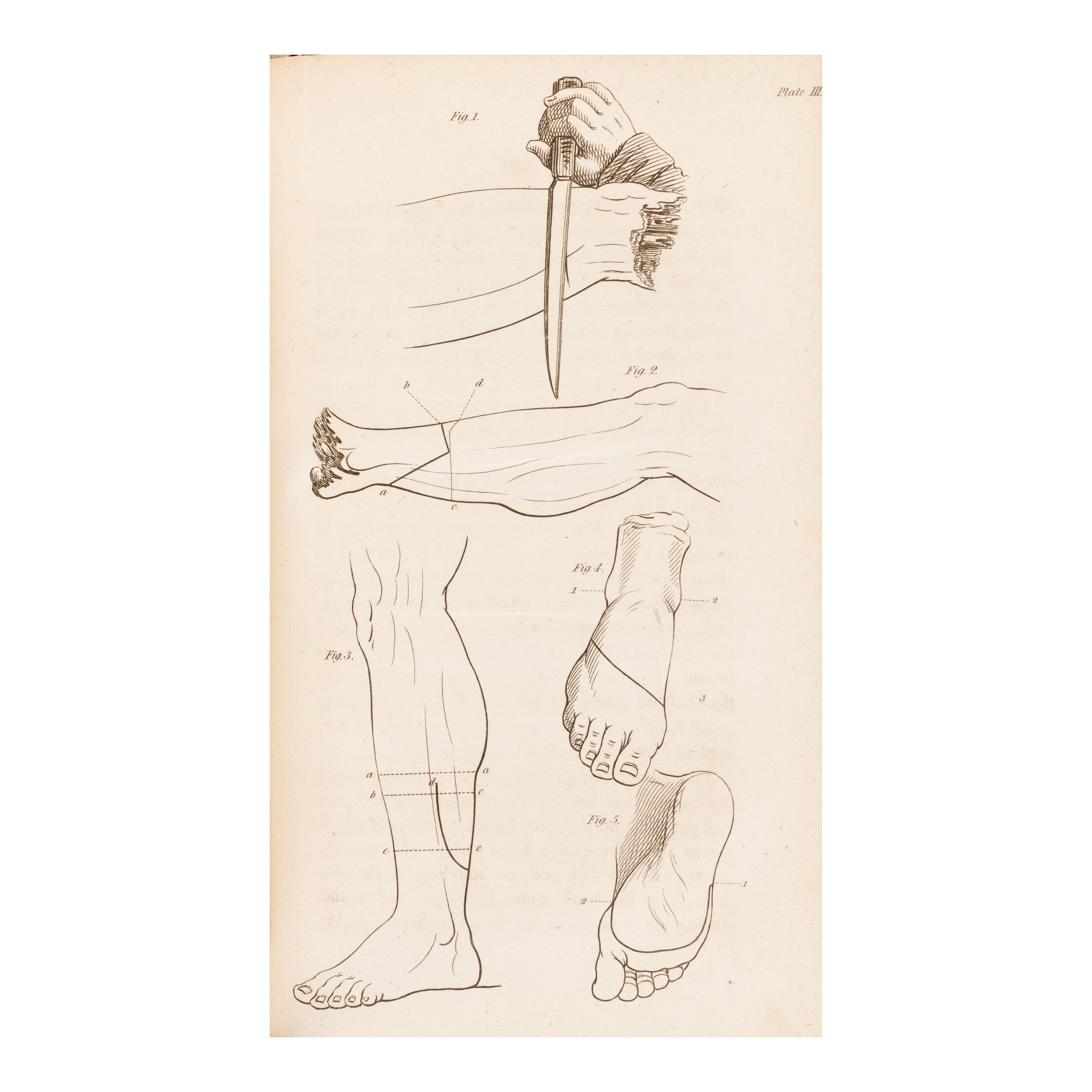 George James | On Gun-Shot Wounds of the Extremities. London: Printed ...