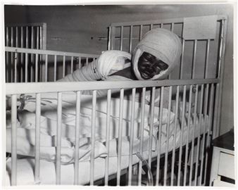 Willie Fletcher Burn Victim Picture