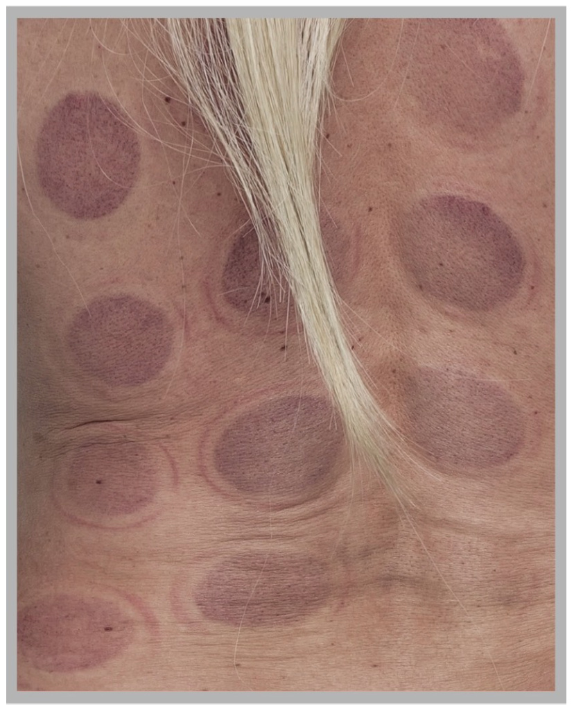 A close-up of human skin showing multiple circular, dark purple marks arranged in a grid pattern with a single strand of light-colored hair crossing the frame.